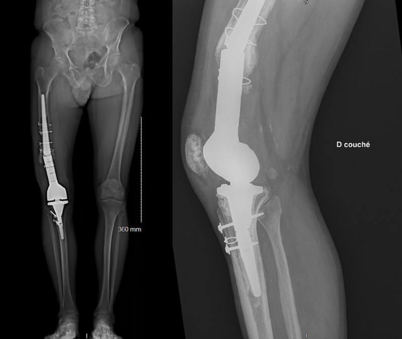 Management of a metaphyseal break of a custom-made massive knee prosthesis : imagery