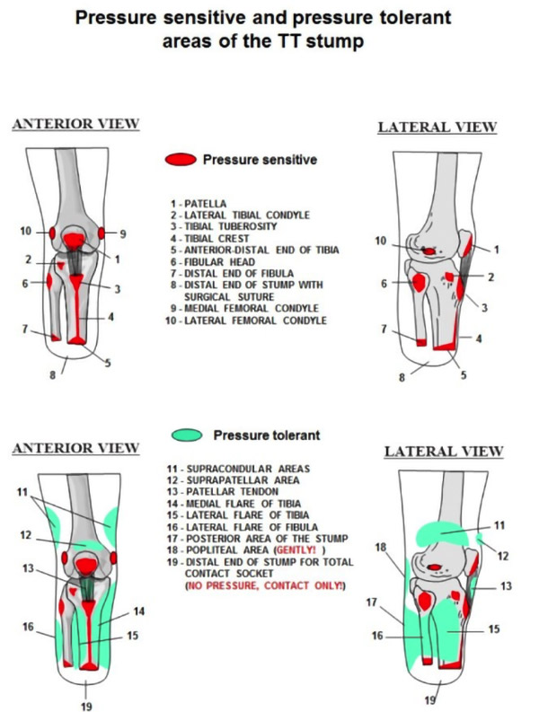 Pressure sensitive and pressure tolerant areas
