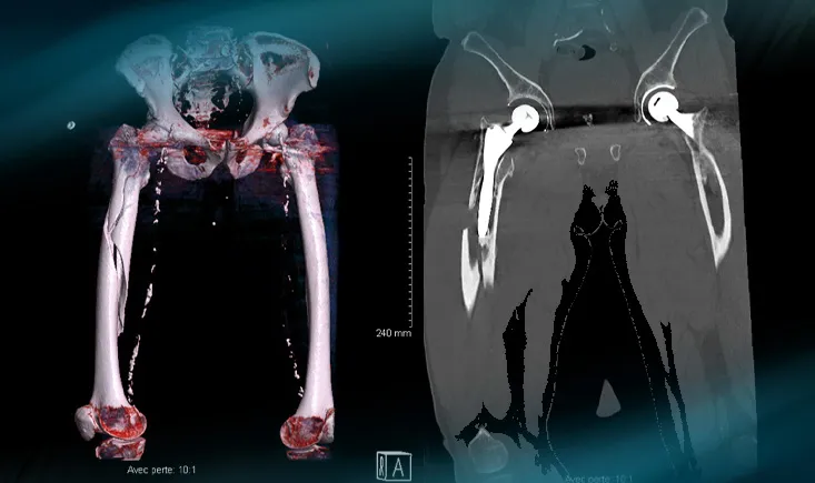 Management of a peri prostetic femoral fracture